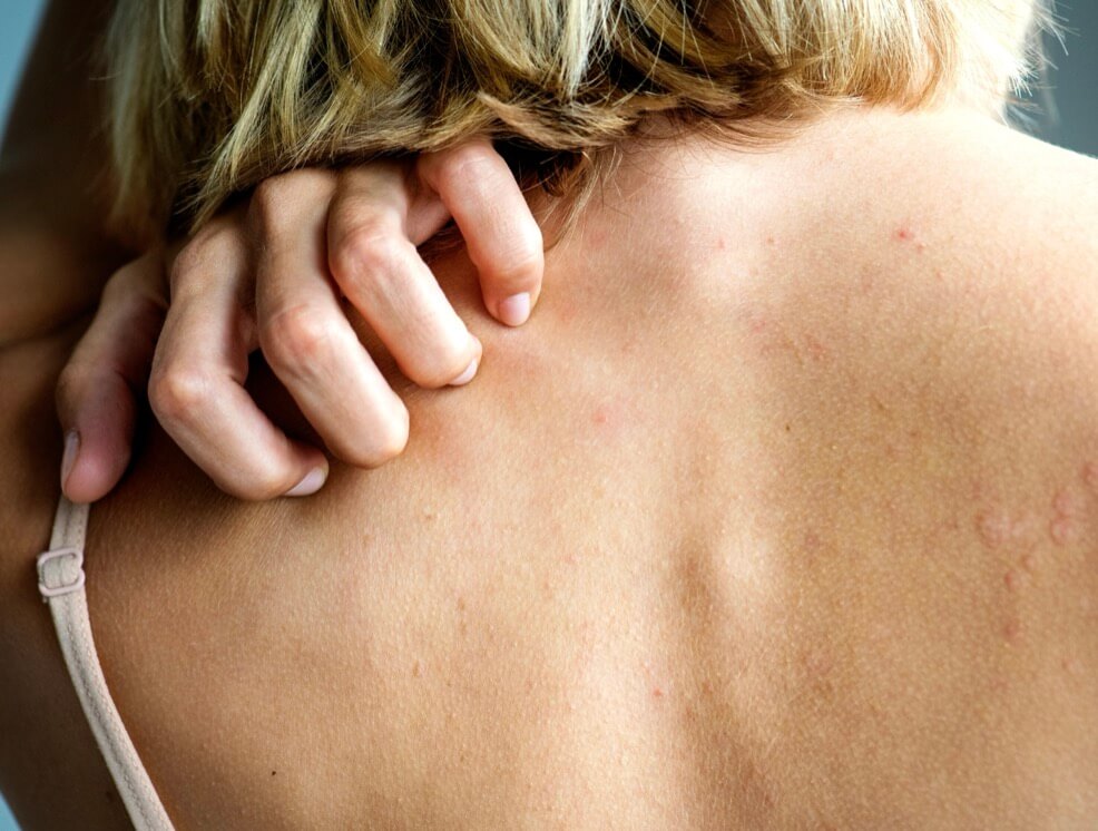 女性ホルモンが乱れてカラダが痒い女性の写真