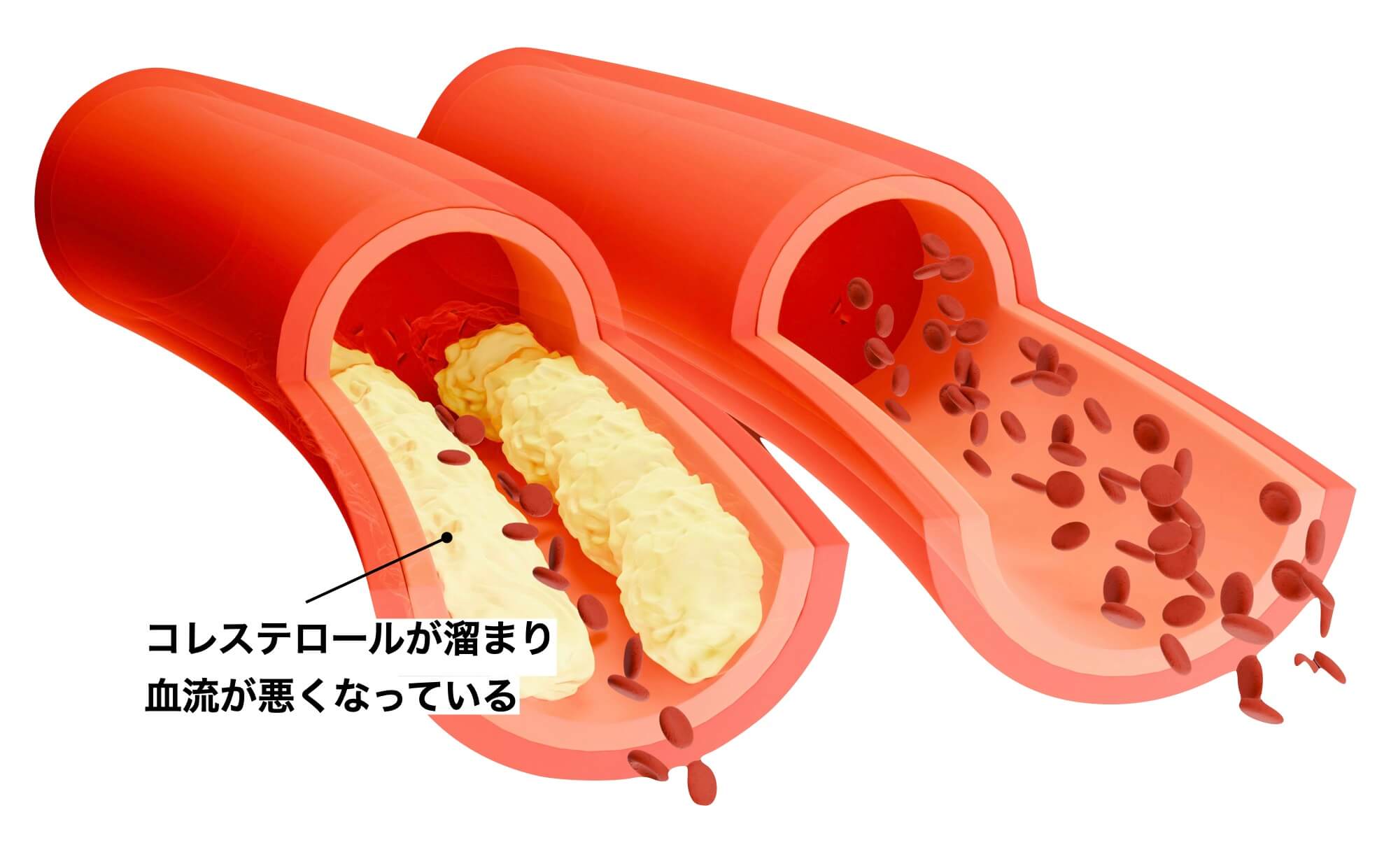 “”コレステロールが溜まり血流が悪くなっている絵