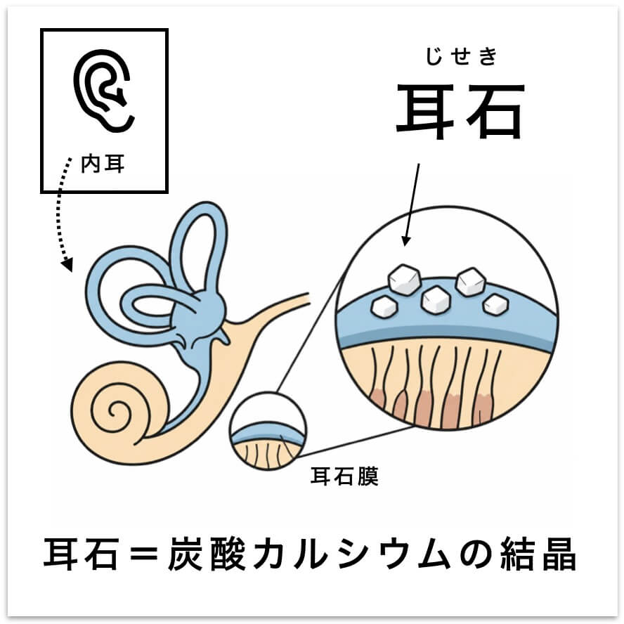 耳石についての説明図