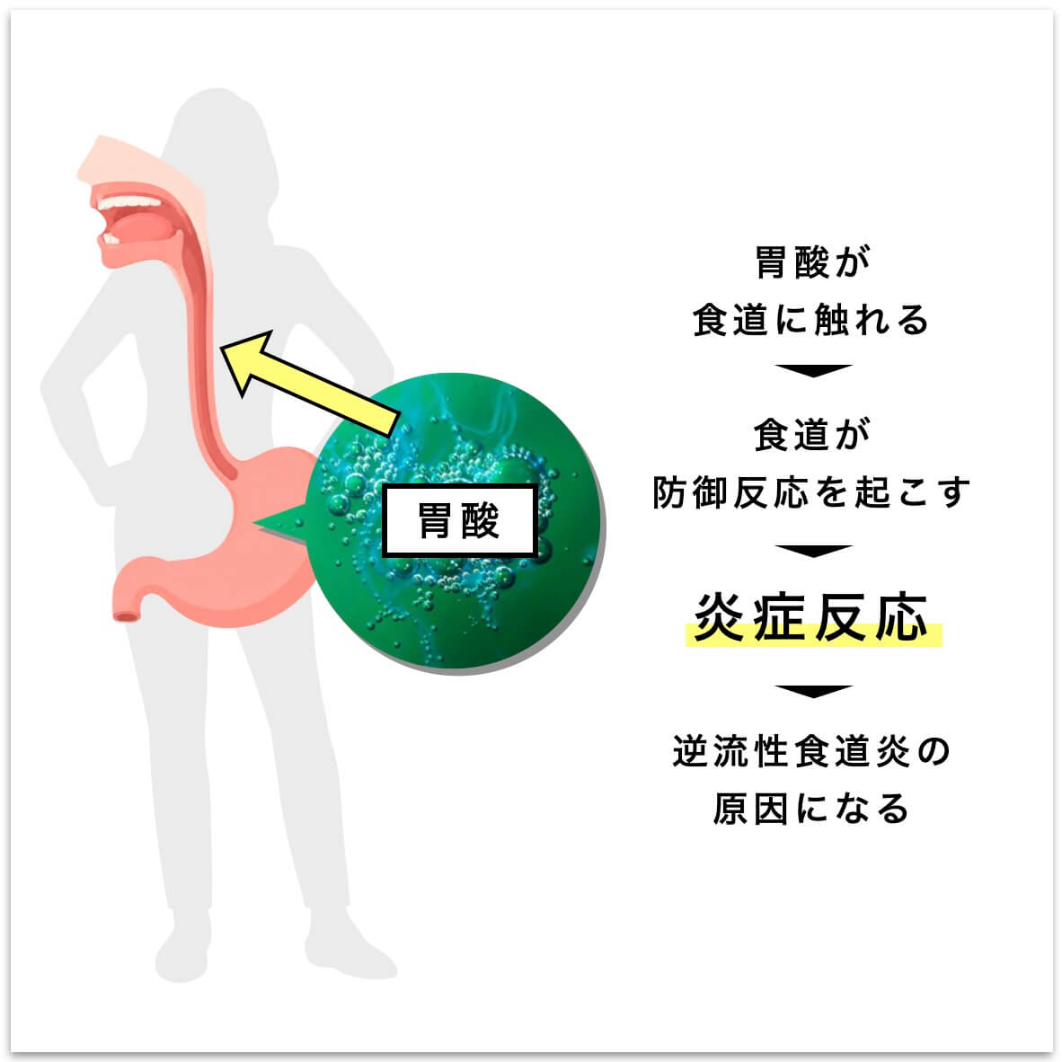 逆流性食道炎の原因
