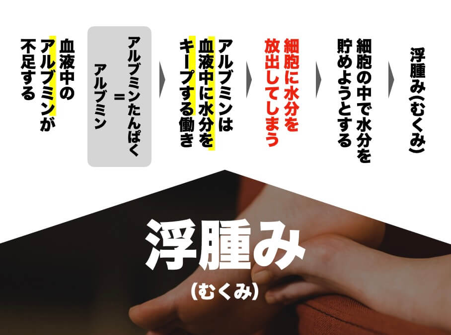 アルブミン蛋白質不足が浮腫む原因を説明した図